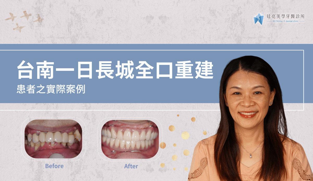 台南一日長城全口重建實際案例｜廷亮美學牙醫診所